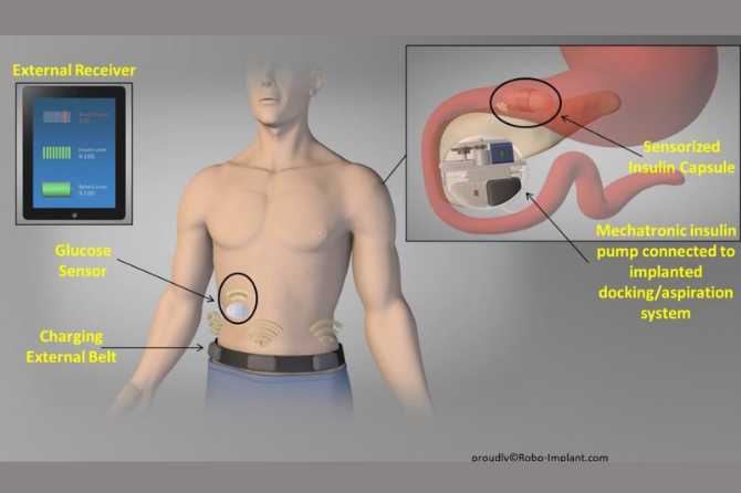 A revolutionary prototype for diabetics, monitored within the framework of ASOC
